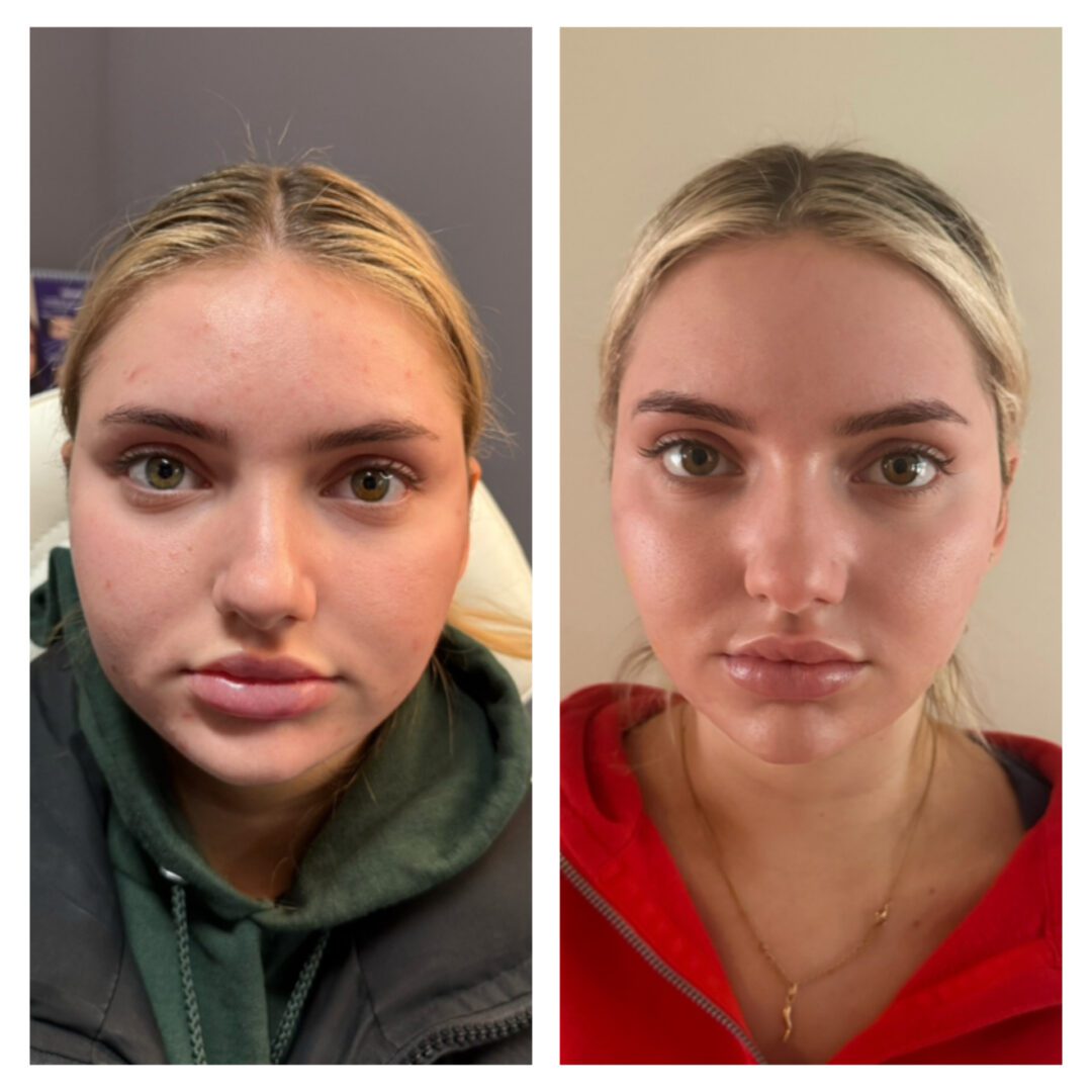 tox before and after